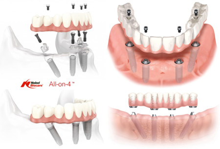 All-on-4-Dental_Implants_St_Charles_IL_60175